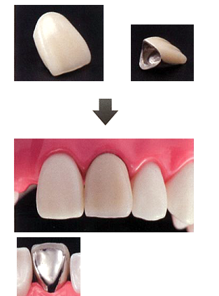 前歯クラウン
