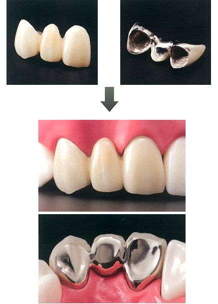 前歯ブリッジ